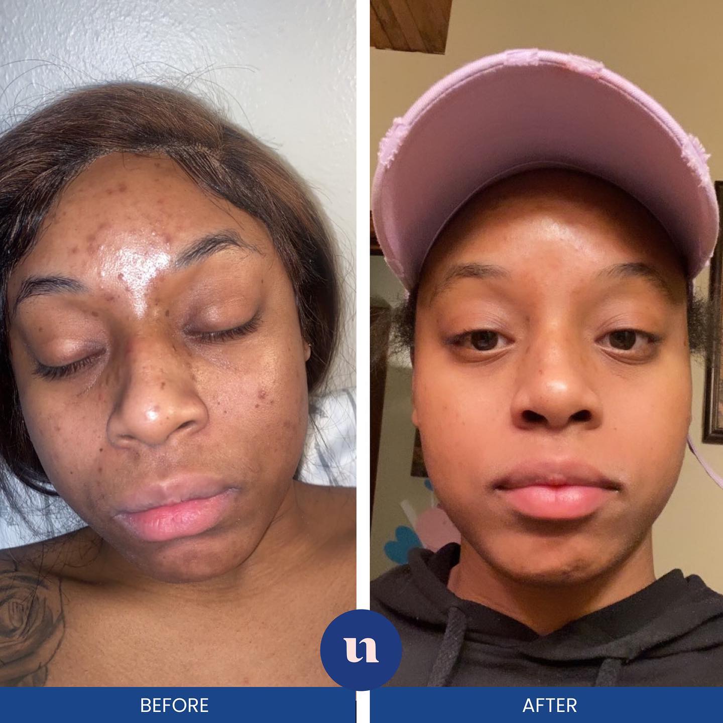 Before using A&H Kit - visible acne and hyperpigmentation