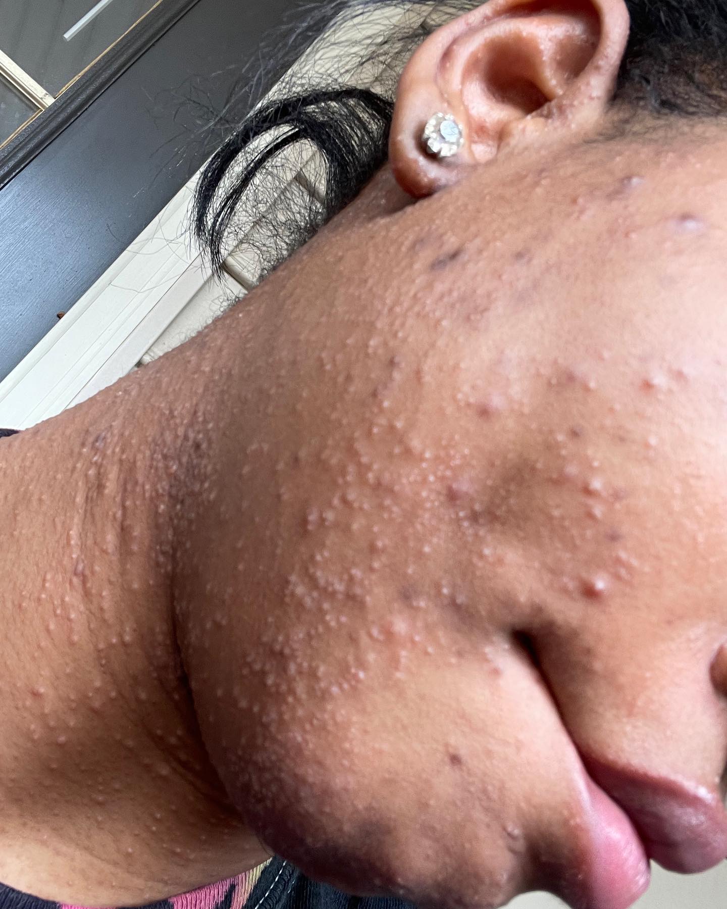 Close-up of skin with hyperpigmentation before using A&H Kit